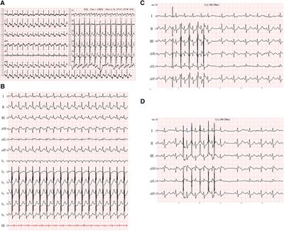 Atrioventricular re-entrant tachycardia and atrioventricular node re-entrant tachycardia in a patient with cancer under chemotherapy: a case report and literature review